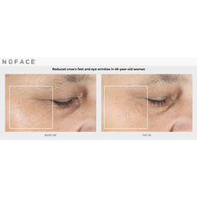 Load image into Gallery viewer, NuFACE before and after crow's feet