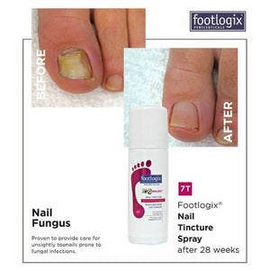 footlogix NAIL TINCTURE SPRAY BEFORE AND AFTER 28 WEEKS