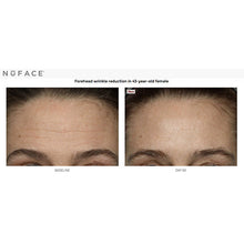 Load image into Gallery viewer, NuFACE before and after forehead wrinkles
