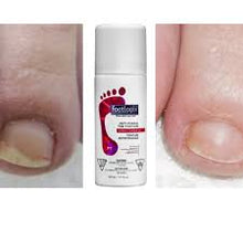 Load image into Gallery viewer, FOOTLOGIX NAIL TINCTURE BEFORE AND AFTER
